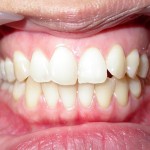 Dental Teeth Whitening