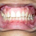 Dental Veneer