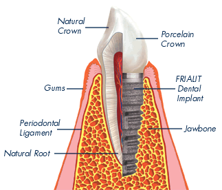 Dental Implants