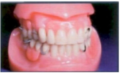 Conventional Partial Dentures