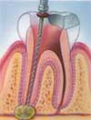 Dental Root Canal / Endodontic