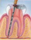 Dental Root Canal / Endodontic