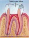 Dental Root Canal / Endodontic